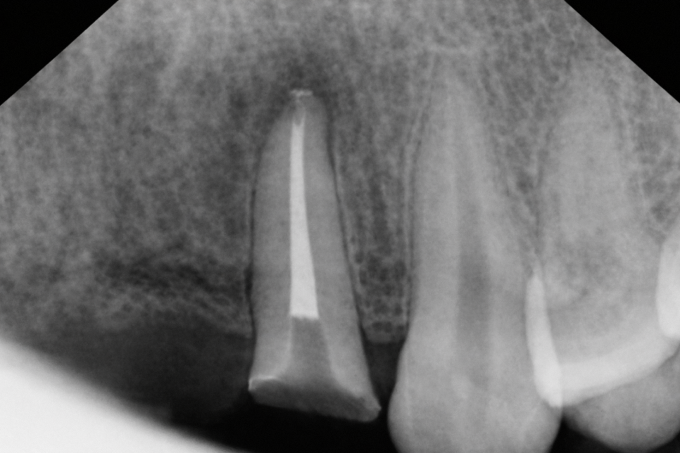 마곡 치과 앞니 깨짐, 레진과 라미네이트 중 무엇이 맞을까? 손상 범위에 따른 치료 방법 관련 이미지 2