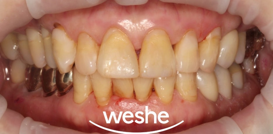 마곡 치과 앞니 파절, 충치 치아 레진으로 하루만에 해결할 수 있을까? 첫인상 하루만에 바꾸기 관련 이미지 7