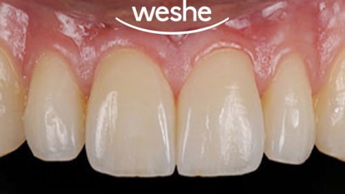 마곡 치과 앞니 깨짐! 레진으로는 부족할 때? 라미네이트(Veneer) 치료 과정 관련 이미지 5