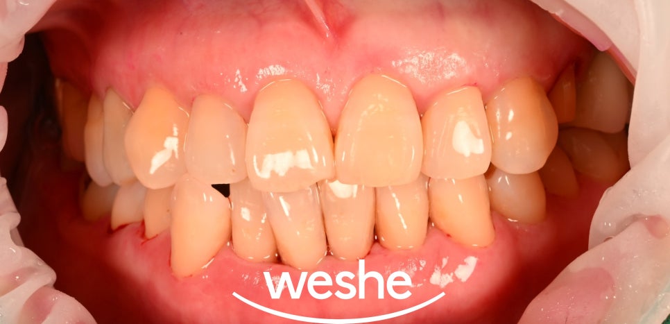 마곡동 치과 EMS 스케일링 관련 이미지 4