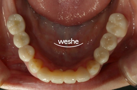 벌어진 치아 사이 (치간이개) 와 치주질환 이 동시에 있을 때, 송정역 치과 임플란트 치료 설명글 관련 이미지 12