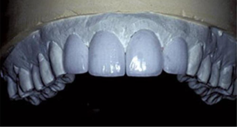 송정 치과 앞니 레진 변색 제거 후 전치부 치아 라미네이트 과정 관련 이미지 5