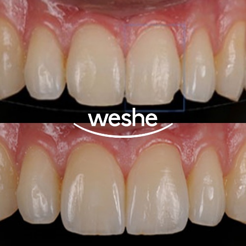마곡 치과 앞니 깨짐! 레진으로는 부족할 때? 라미네이트(Veneer) 치료 과정 관련 이미지 6