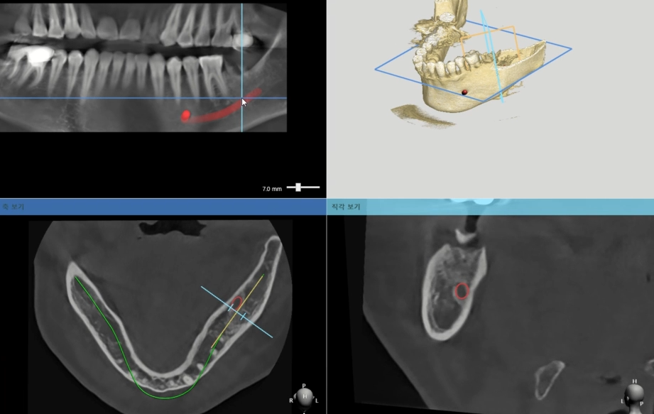 위턱 전체 임플란트 마곡동 치과 수면치료(의식하진정법)을 활용한 진료 방법 관련 이미지 4