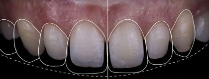 강서구 치과 앞니 라미네이트 제작을 위한 단계 진단 및 분석 절차 과정은? 관련 이미지 5