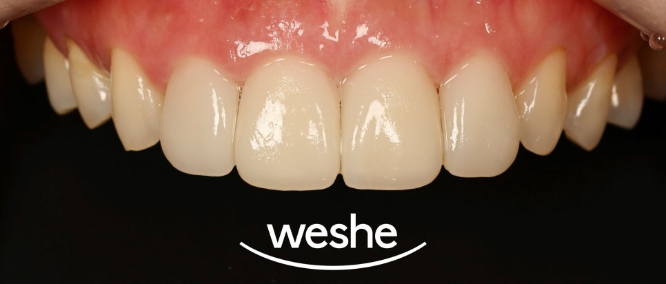 앞니 레진 변색, 티 안 나는 라미네이트 교체와 비율 개선할 수 있을까? 마곡역 치과 관련 이미지 5