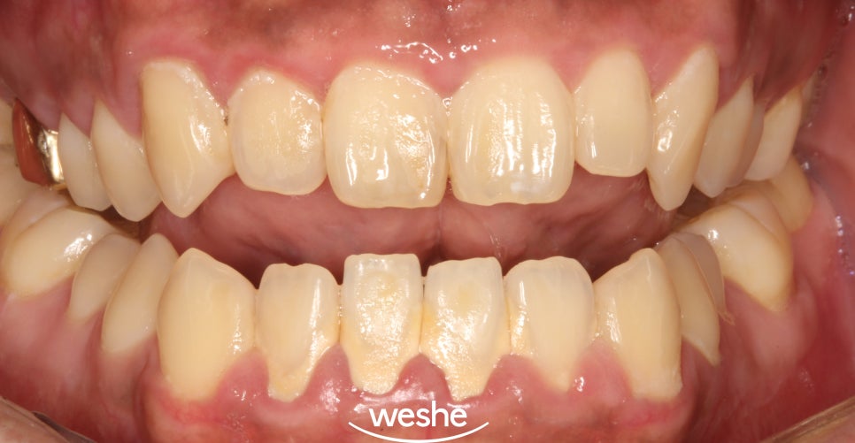 발산 치과 에어플로우 스케일러 를 활용한 치석제거 과정 관련 이미지 5