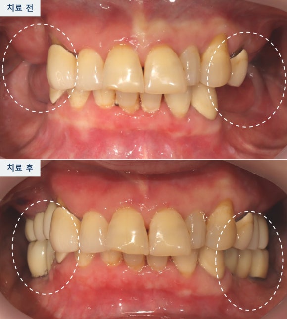 위 어금니 잇몸뼈가 부족하다면? 상악동 거상술이 필요한 이유 관련 이미지 7