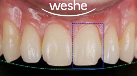 마곡 치과 앞니 깨짐! 레진으로는 부족할 때? 라미네이트(Veneer) 치료 과정 관련 이미지 1