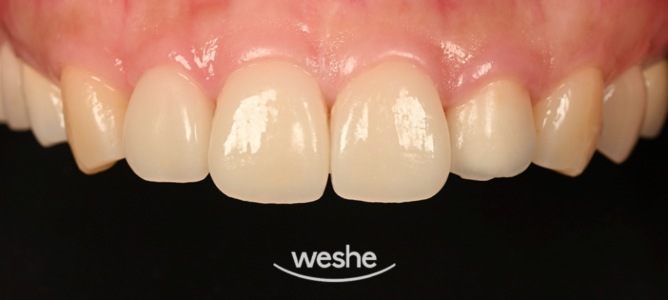 마곡동 치과 라미네이트 앞니 미세 파절, 변색 치료 사례 분석정리 관련 이미지 4