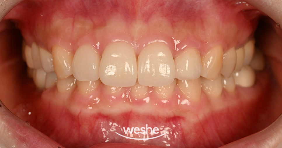 마곡동 치과 라미네이트 앞니 미세 파절, 변색 치료 사례 분석정리 관련 이미지 3