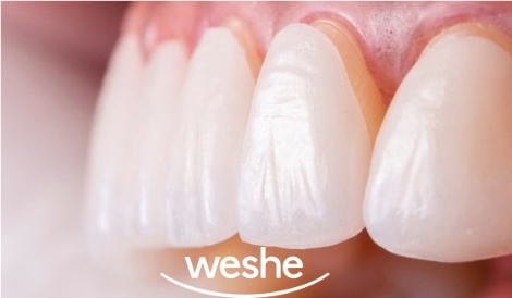 마곡역 치과 삐뚤빼뚤하고 치아 끝 살짝 깨진 앞니, 교정 대신 라미네이트 수복으로 치료 과정 관련 이미지 2