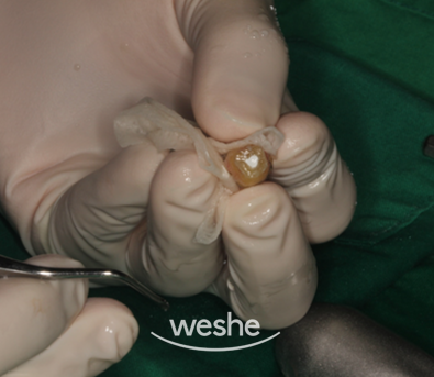 마곡역치과 치아, 진짜 뽑아야 되는 걸까요? 치아재식술이란? 관련 이미지 6