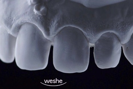 😁 웃을 때 치아 사이 가 벌어져 보인다면? 마곡동 치과 라미네이트 로 해결! 관련 이미지 9