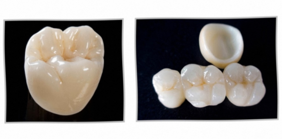 The Longevity of Cosmetic Restorations at a Gangseo-gu Dental Clinic Is Determined by Care More Than Materials image 2