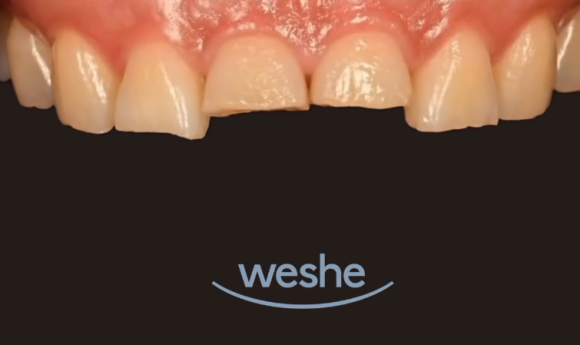 What Does a Conservative Dentistry Specialist Look at First When Considering Laminates? image 5