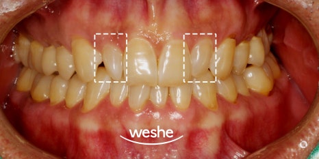 유독 작은 치아 어떻게 해결할 수 있나요? 마곡역 치과 앞니 왜소치 라미네이트 치료 과정 관련 이미지 3