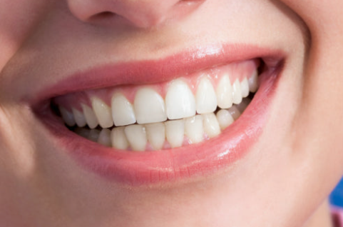Magok Teeth Whitening: WISH Whitening Combining Professional and At-Home Whitening image 12