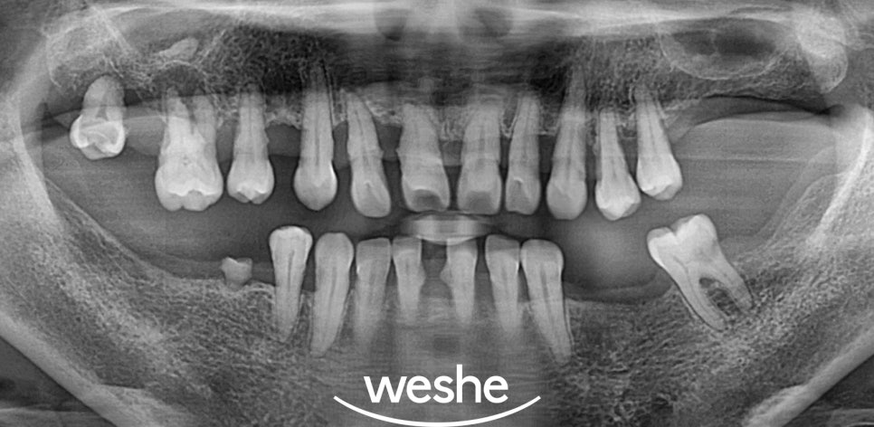 벌어진 치아 사이 (치간이개) 와 치주질환 이 동시에 있을 때, 송정역 치과 임플란트 치료 설명글 관련 이미지 6