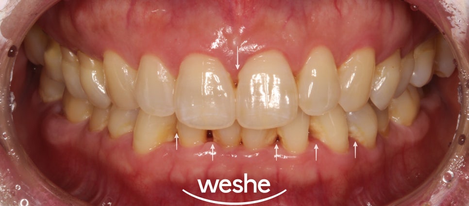 송정역 치과 잇몸 내려앉음이 나타날 때 할 수 있는 아랫니 치석 제거, 집에서도 할 수 있을까요? 관련 이미지 5