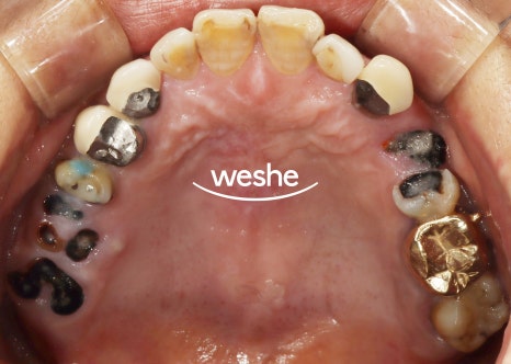마곡역 치과 기공실과 기공소의 차이와 그에 따른 임플란트 진료 과정 관련 이미지 7