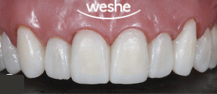 송정 치과 치아 배열이 틀어졌을 때, 앞니 라미네이트 치료 과정 관련 이미지 7