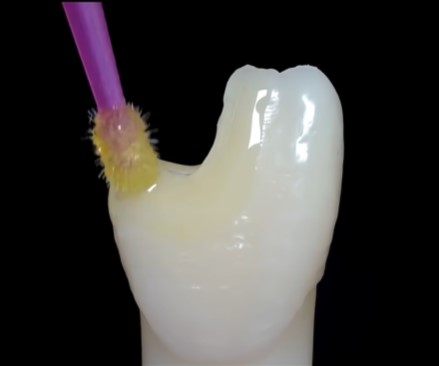 마곡동 치과 치아 파절 로 인한 레진 치료, 어떤 경우에 가능할까요? 관련 이미지 4