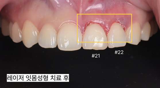 앞니가 깨졌을 때 어떤 치료가 필요할까요? 레진부터 임플란트까지 관련 이미지 3