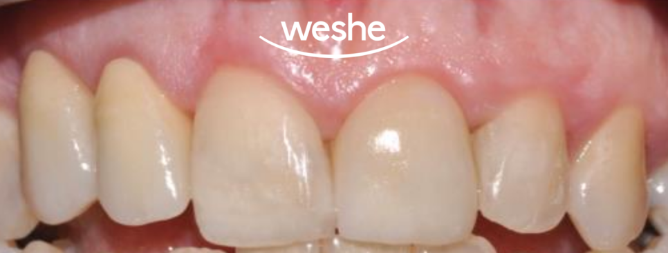 앞니 치아 파절 과 잇몸 염증, 마곡동 치과 의 라미네이트 보철 치료 과정 관련 이미지 4