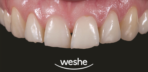 앞니 끝 깨짐 발산 치과 치아 라미네이트 치료 과정 관련 이미지 1