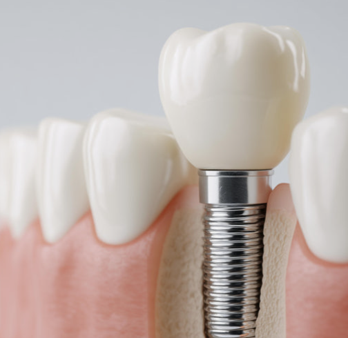 Is a Loose Dental Implant a Sign That Revision Surgery Is Needed? image 8