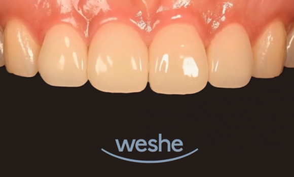 What Does a Conservative Dentistry Specialist Look at First When Considering Laminates? image 4