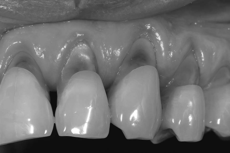 마곡 치과 치아가 길어 보이는건 노화 때문? 원인과 치료법이 알고 싶다 관련 이미지 8