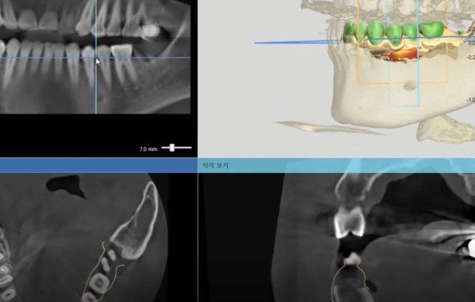 강서구 마곡 치과 [전신질환 임플란트] 골다공증 환자를 위한 안전 수술 가이드 관련 이미지 3