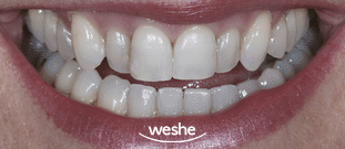 송정 치과 치아 배열이 틀어졌을 때, 앞니 라미네이트 치료 과정 관련 이미지 1