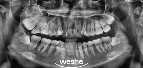 마곡역 수면치과 사랑니 발치 를 하는데 방해되는 덴탈 포비아, 극복할 수 있을까? 관련 이미지 4