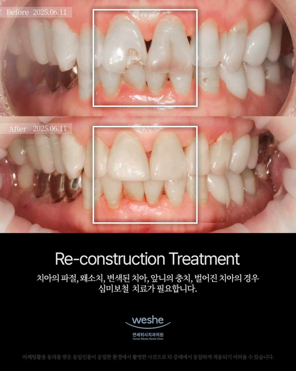 ✨ Re-construction Treatment &ndash; 레진 치료 전후 ✨ 관련 이미지 1