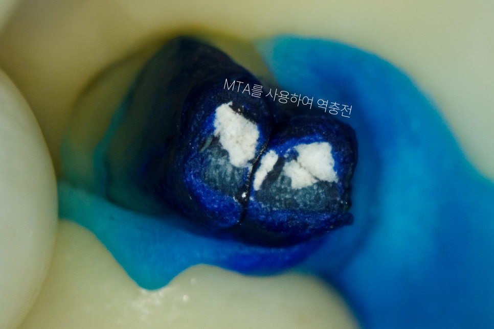 마곡 치과 치아재식술 발치 전 자연치를 살리는 과정 관련 이미지 8