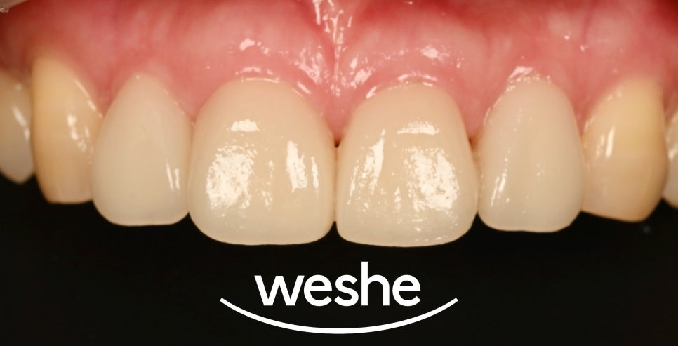 앞니 벌어진 틈, 자연스럽게 해결하는 방법은? 라미네이트 치료 과정을 송정역 치과 에서 소개해 드리도록 하겠습니다. 관련 이미지 6