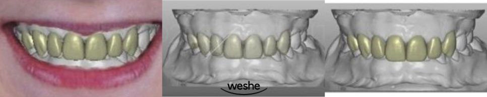 😁 웃을 때 치아 사이 가 벌어져 보인다면? 마곡동 치과 라미네이트 로 해결! 관련 이미지 7