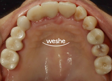 벌어진 치아 사이 (치간이개) 와 치주질환 이 동시에 있을 때, 송정역 치과 임플란트 치료 설명글 관련 이미지 11