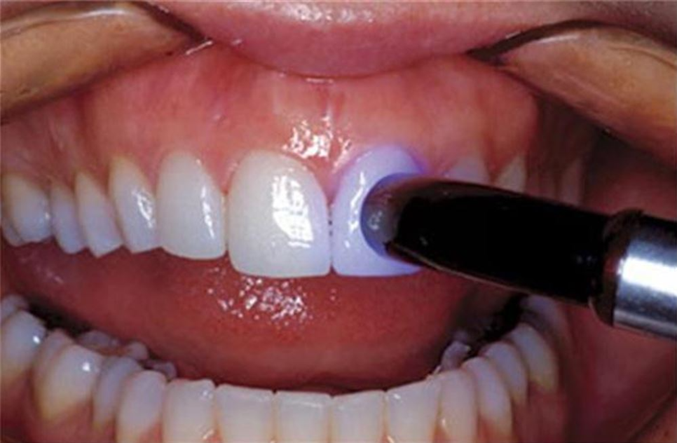 송정 치과 앞니 레진 변색 제거 후 전치부 치아 라미네이트 과정 관련 이미지 10