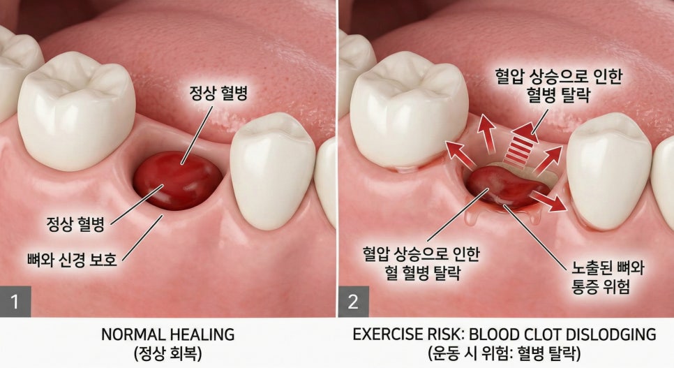 마곡 치과 치아 발치 후 운동·식사·음주, 언제부터 괜찮을까요? 관련 이미지 1
