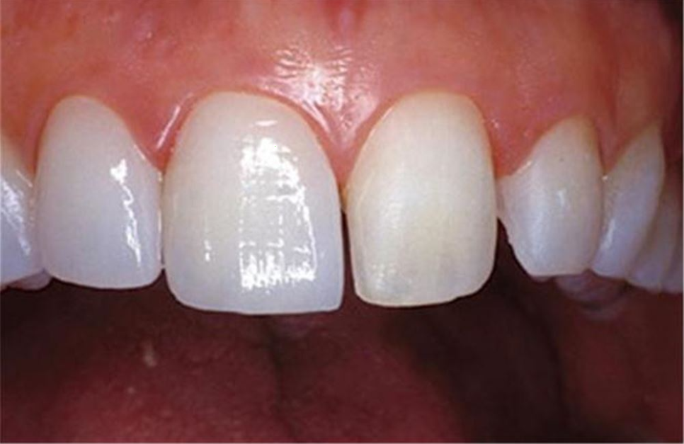 송정 치과 앞니 레진 변색 제거 후 전치부 치아 라미네이트 과정 관련 이미지 7