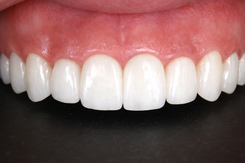 마곡역 치과 신경치료 후 크라운까지 마무리하는 진짜 이유와 지르코니아의 장점 관련 이미지 5