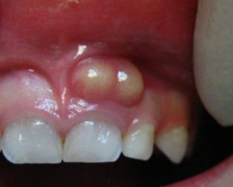 A Pus Pocket on the Gums: Will It Get Better with Antibiotics Alone? image 6