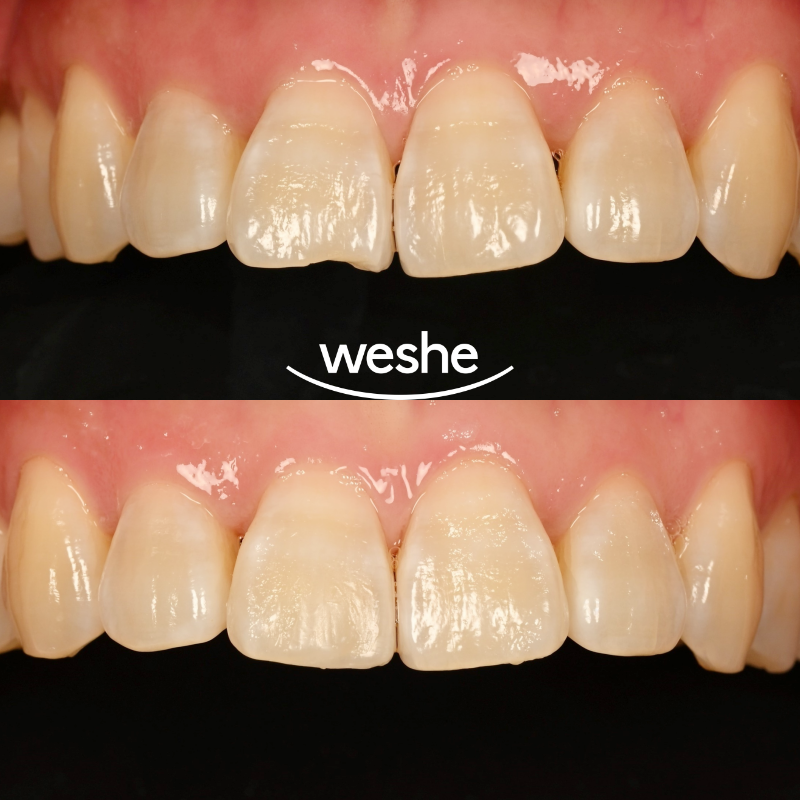 마곡 치과 에서 알려드리는 앞니 끝 깨짐, 치아 파절 레진 치료 방법 관련 이미지 7