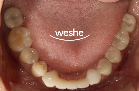 마곡역 치과 기공실과 기공소의 차이와 그에 따른 임플란트 진료 과정 관련 이미지 13