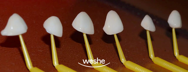 [강서구 치과] 치간이개, 앞니가 벌어졌다?! 치아 벌어짐, 초기 충치/ 라미네이트 치료 과정 관련 이미지 5