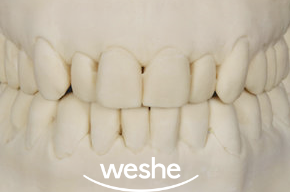 송정 치과 치아 배열이 틀어졌을 때, 앞니 라미네이트 치료 과정 관련 이미지 2